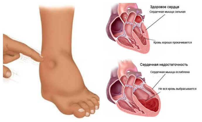 причины сердечных отеков ног