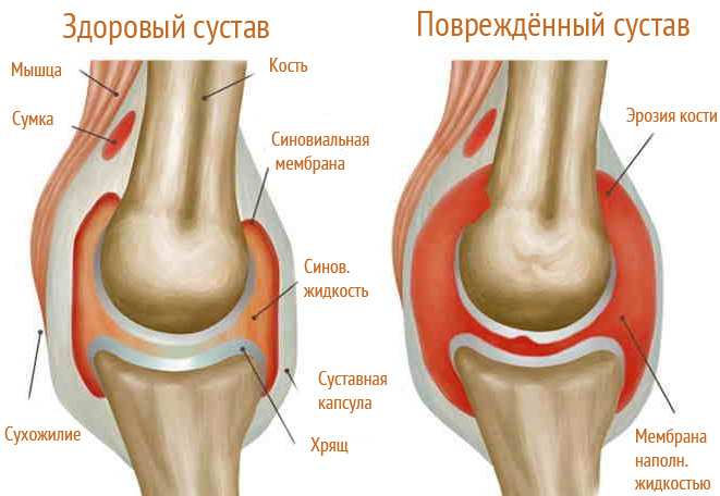 подагра